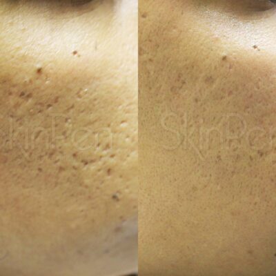 SkinPen Therapy