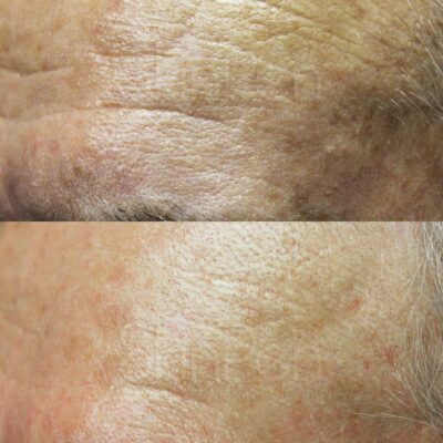 SkinPen Therapy Before/After