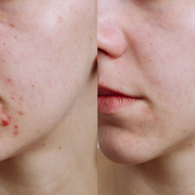 Acne treatment Ingleby Barwick