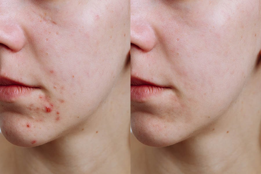 Acne treatment Ingleby Barwick