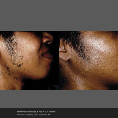 Cynosure before and after hair removal dark skin face