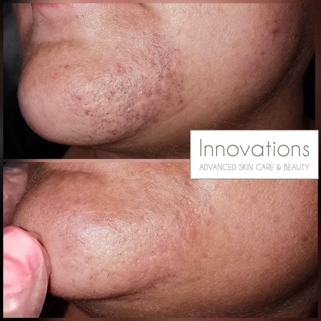 Amazing results with Cynosure laser hair removal after 1 session. -  Innovations Skin Clinic