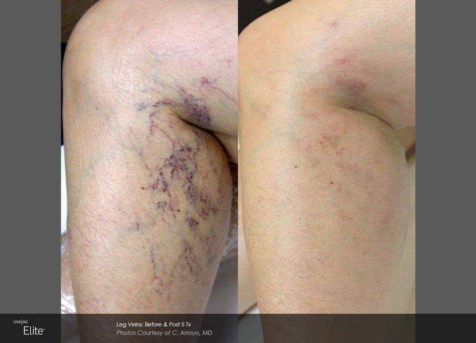 vein treatment