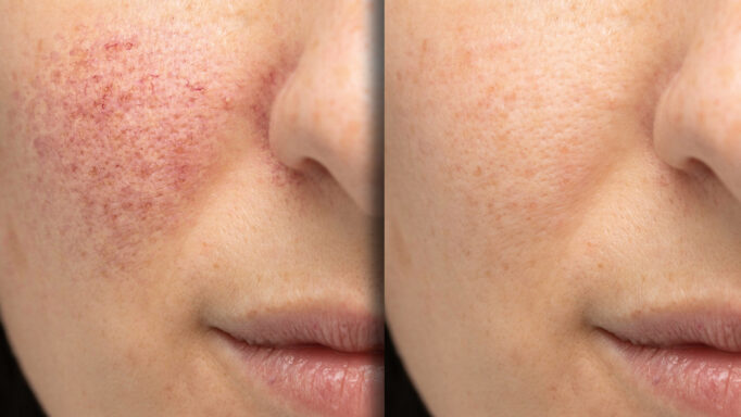 redness reduction from dmk treatment