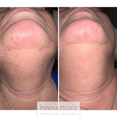 before and after laser hair removal chin and neck