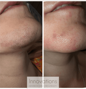 before and after laser hair removal dark hair on chin