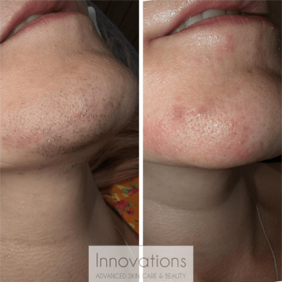 before and after laser hair removal dark hair on chin