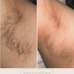 before and after laser hair removal underarm