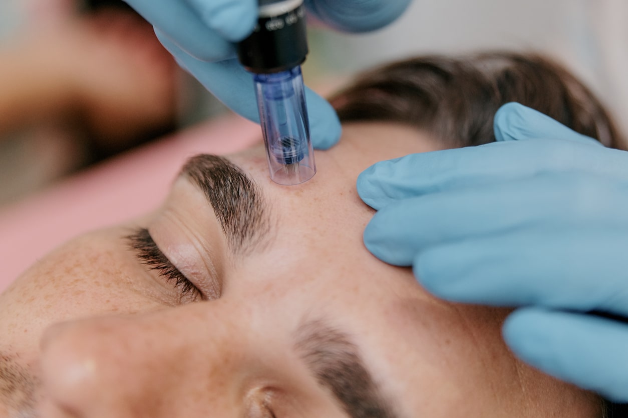 man receiving skinpen microneedling treatment